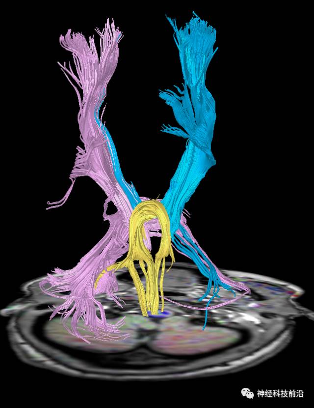 DWI序列脑干、内囊后肢高信号纤维束解析