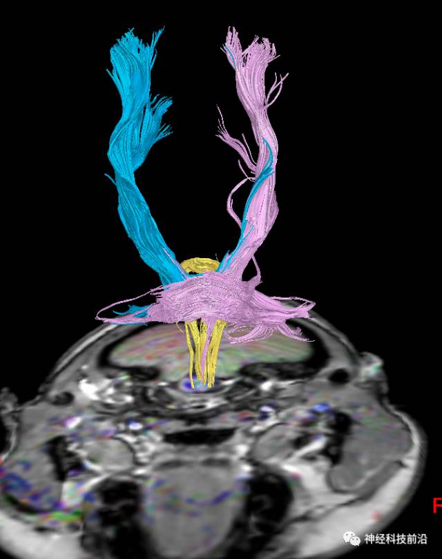 DWI序列脑干、内囊后肢高信号纤维束解析