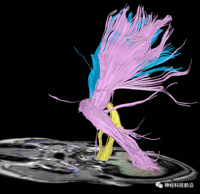 DWI序列脑干、内囊后肢高信号纤维束解析