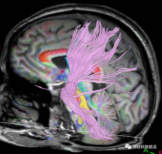 DWI序列脑干、内囊后肢高信号纤维束解析