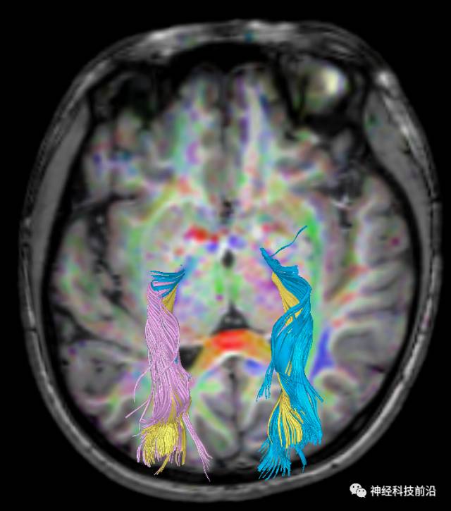 DWI序列脑干、内囊后肢高信号纤维束解析