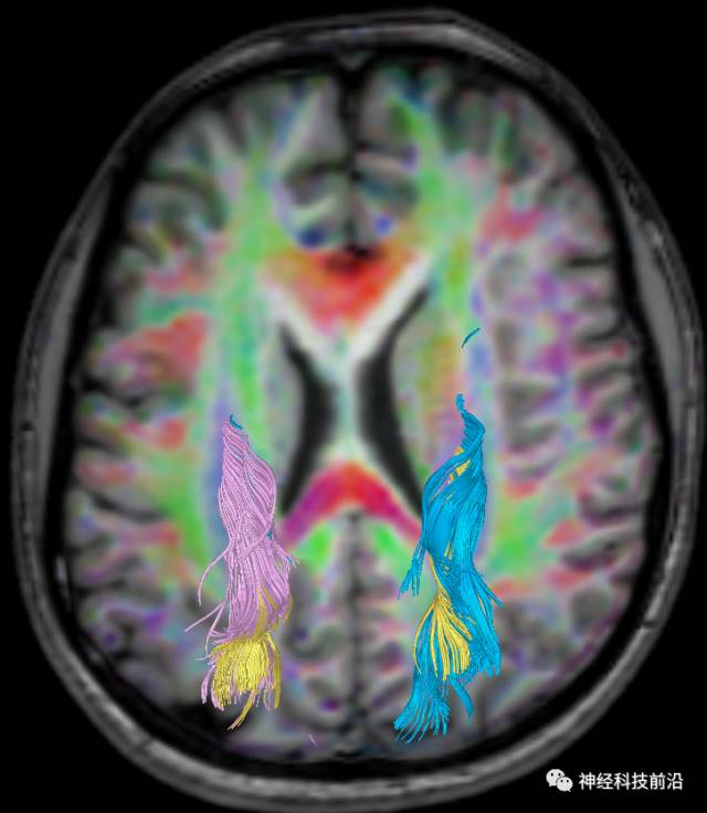 DWI序列脑干、内囊后肢高信号纤维束解析