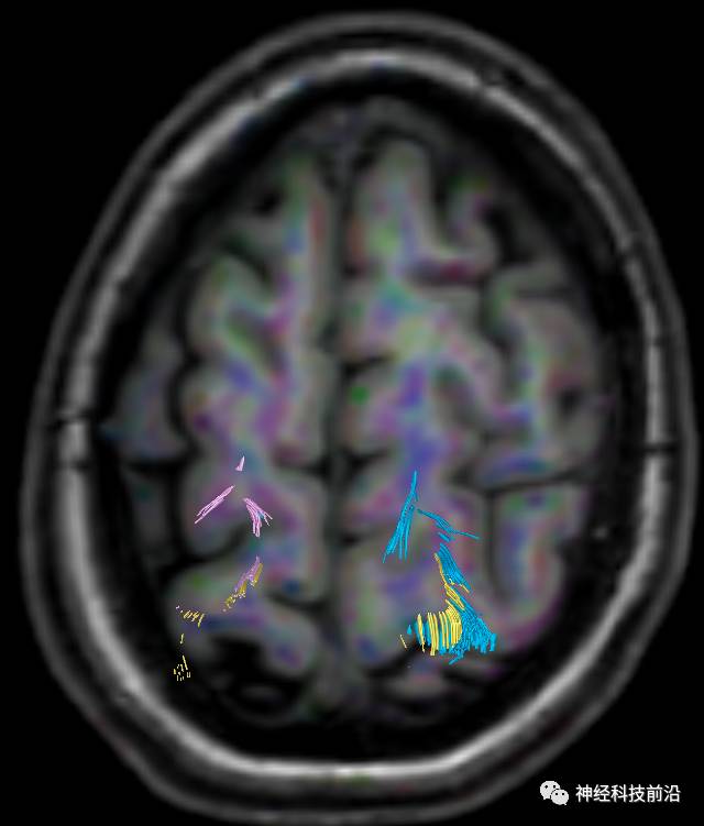 DWI序列脑干、内囊后肢高信号纤维束解析
