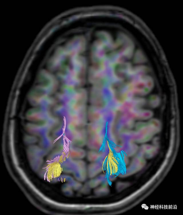 DWI序列脑干、内囊后肢高信号纤维束解析