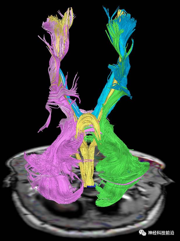DWI序列脑干、内囊后肢高信号纤维束解析