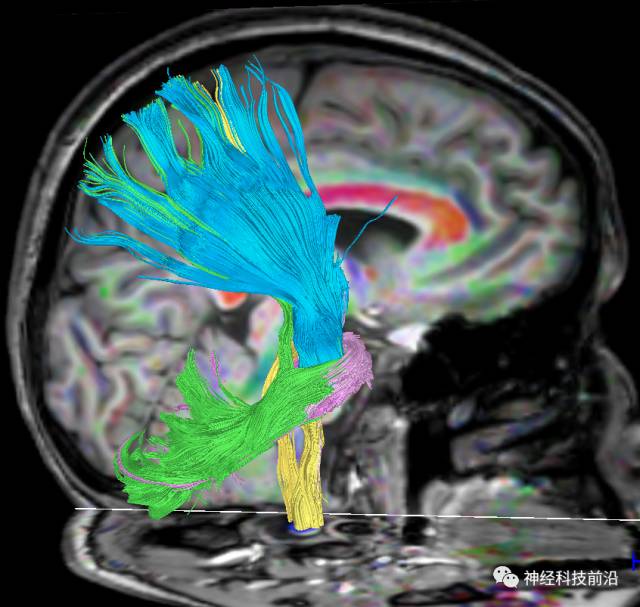 DWI序列脑干、内囊后肢高信号纤维束解析