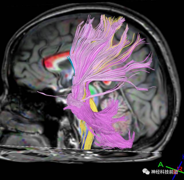 DWI序列脑干、内囊后肢高信号纤维束解析