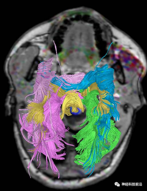 DWI序列脑干、内囊后肢高信号纤维束解析
