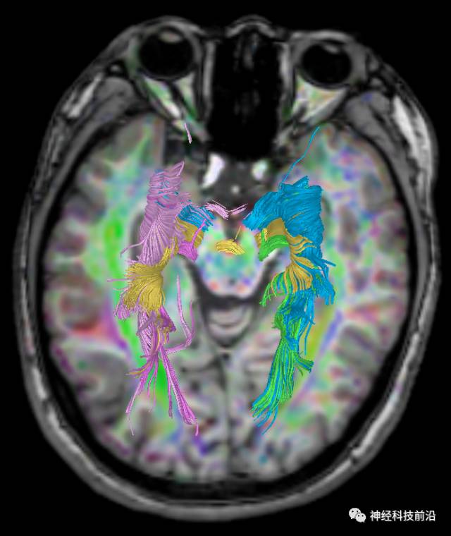 DWI序列脑干、内囊后肢高信号纤维束解析
