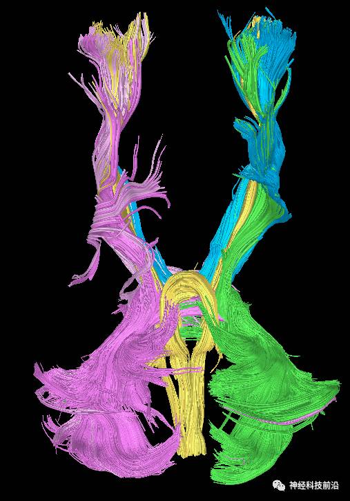 DWI序列脑干、内囊后肢高信号纤维束解析