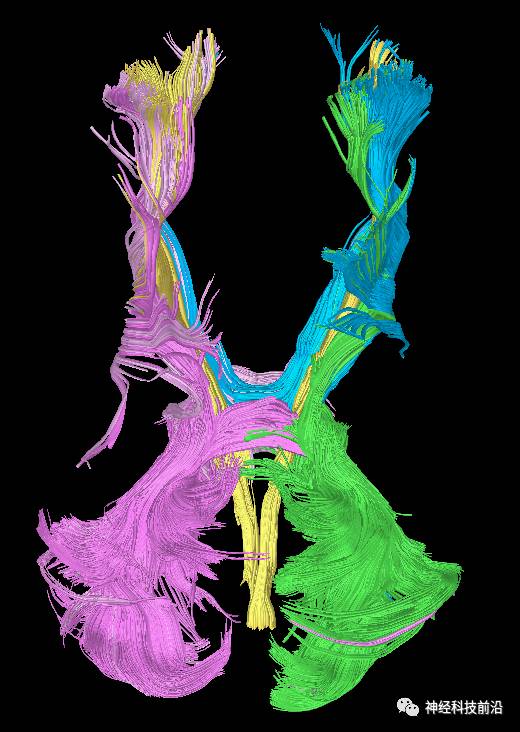 DWI序列脑干、内囊后肢高信号纤维束解析