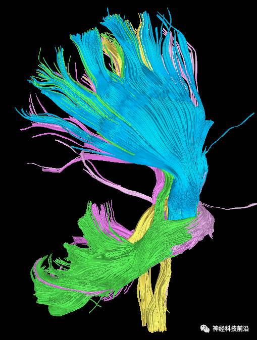 DWI序列脑干、内囊后肢高信号纤维束解析