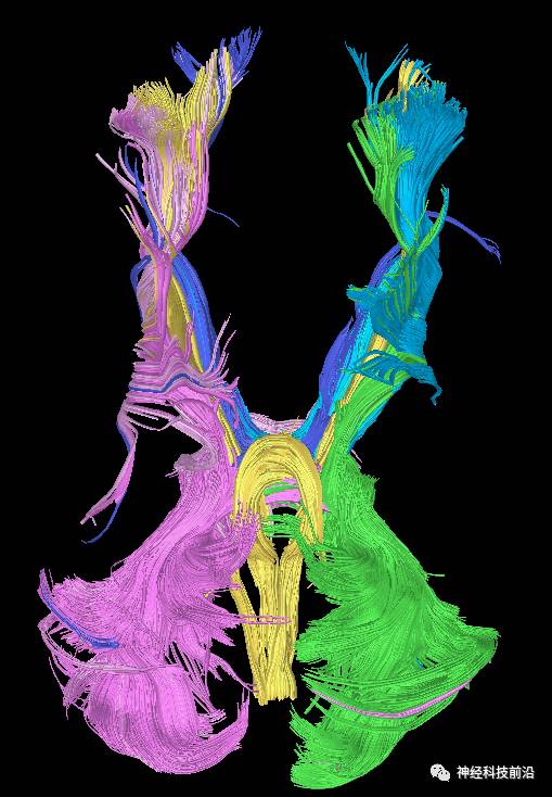 DWI序列脑干、内囊后肢高信号纤维束解析