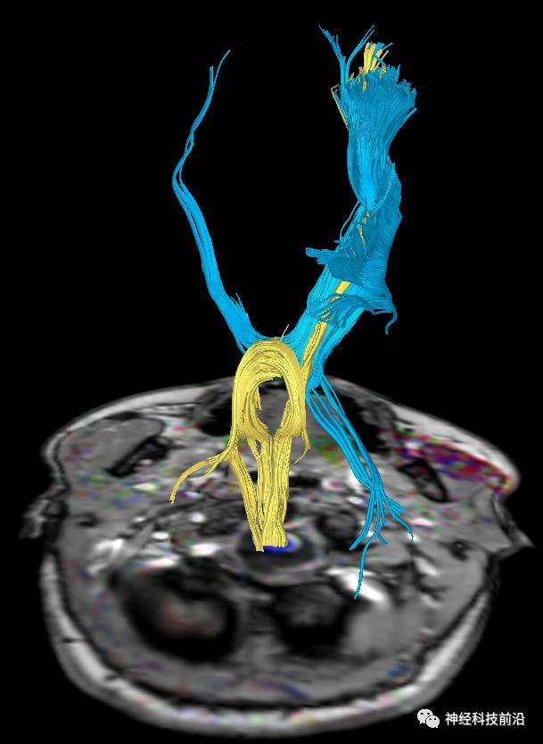 DWI序列脑干、内囊后肢高信号纤维束解析