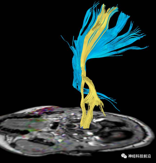 DWI序列脑干、内囊后肢高信号纤维束解析