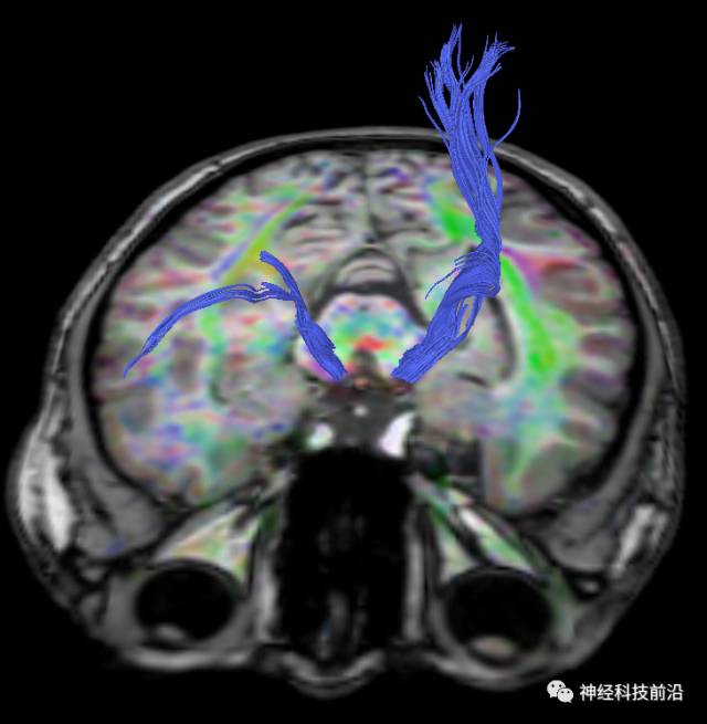 DWI序列脑干、内囊后肢高信号纤维束解析