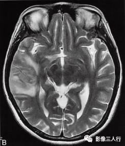 【病例】脑实质横纹肌样脑膜瘤1例MR