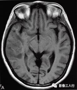 【病例】脑实质横纹肌样脑膜瘤1例MR