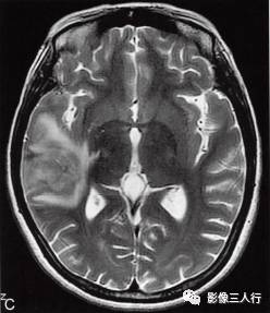 【病例】脑实质横纹肌样脑膜瘤1例MR