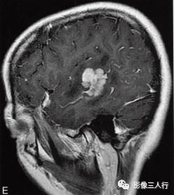 【病例】脑实质横纹肌样脑膜瘤1例MR