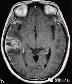 【病例】脑实质横纹肌样脑膜瘤1例MR