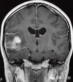 【病例】脑实质横纹肌样脑膜瘤1例MR