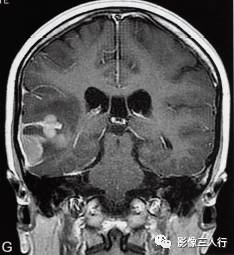 【病例】脑实质横纹肌样脑膜瘤1例MR