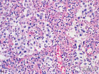 【病例】脑实质横纹肌样脑膜瘤1例MR