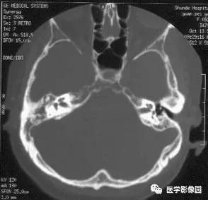 中耳癌  cancer of the middle ear