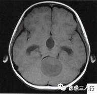 【病例】小脑毛细胞型星形细胞瘤1例MR影像分析