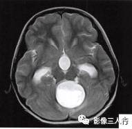 【病例】小脑毛细胞型星形细胞瘤1例MR影像分析