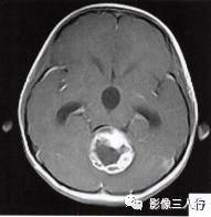 【病例】小脑毛细胞型星形细胞瘤1例MR影像分析