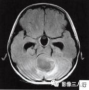 【病例】小脑毛细胞型星形细胞瘤1例MR影像分析