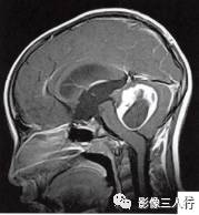 【病例】小脑毛细胞型星形细胞瘤1例MR影像分析