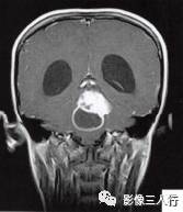 【病例】小脑毛细胞型星形细胞瘤1例MR影像分析