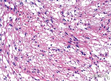 【病例】小脑毛细胞型星形细胞瘤1例MR影像分析