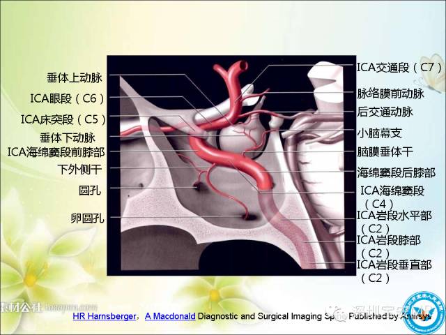 【PPT】颈内动脉颅内段影像解剖(附临床血管病例)