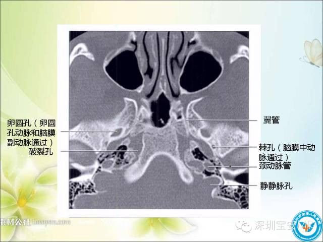 【PPT】颈内动脉颅内段影像解剖(附临床血管病例)
