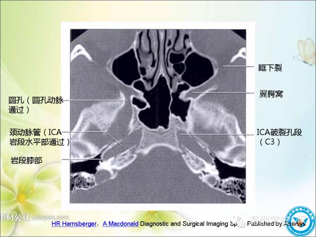 【PPT】颈内动脉颅内段影像解剖(附临床血管病例)