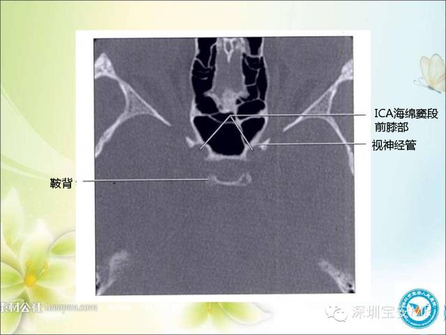 【PPT】颈内动脉颅内段影像解剖(附临床血管病例)