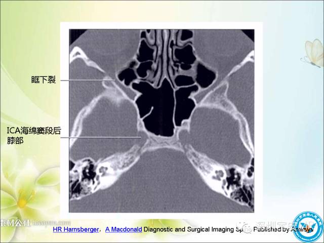 【PPT】颈内动脉颅内段影像解剖(附临床血管病例)