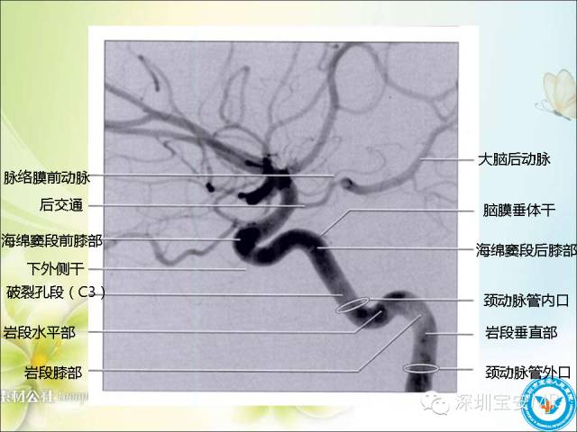 【PPT】颈内动脉颅内段影像解剖(附临床血管病例)