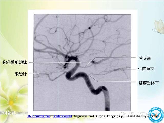 【PPT】颈内动脉颅内段影像解剖(附临床血管病例)