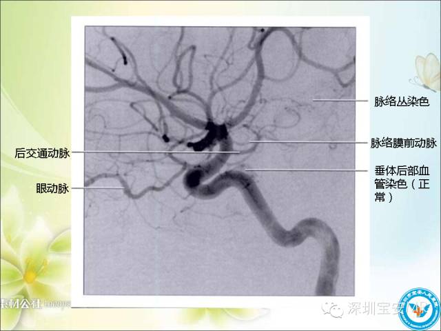 【PPT】颈内动脉颅内段影像解剖(附临床血管病例)