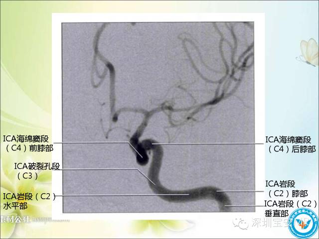 【PPT】颈内动脉颅内段影像解剖(附临床血管病例)