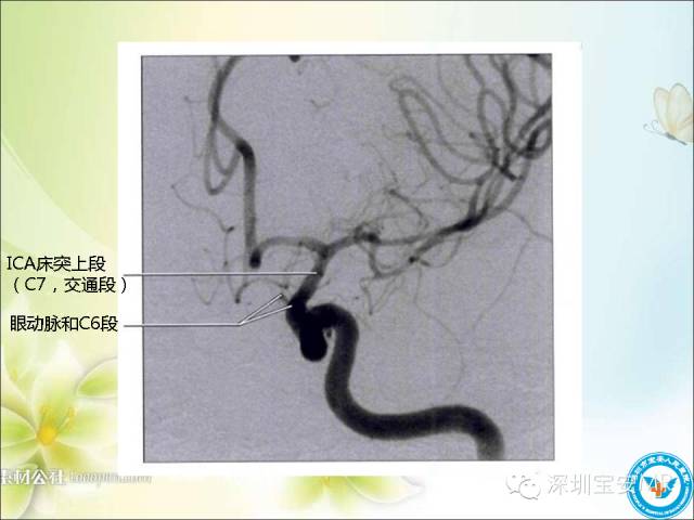 【PPT】颈内动脉颅内段影像解剖(附临床血管病例)