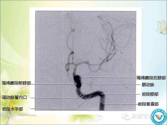 【PPT】颈内动脉颅内段影像解剖(附临床血管病例)