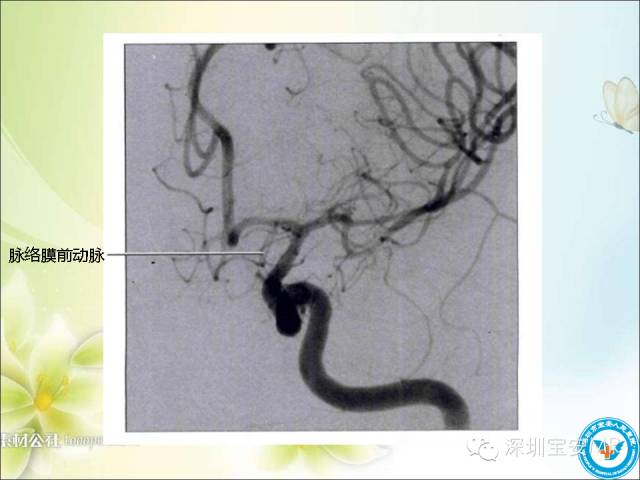 【PPT】颈内动脉颅内段影像解剖(附临床血管病例)