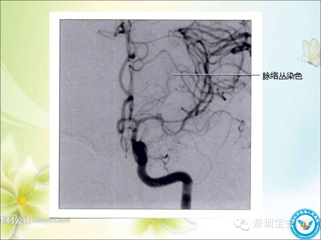 【PPT】颈内动脉颅内段影像解剖(附临床血管病例)