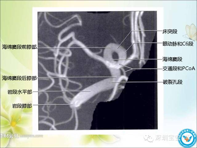 【PPT】颈内动脉颅内段影像解剖(附临床血管病例)